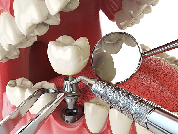 Best Emergency Treatment for Oral Infections in Craig, CO